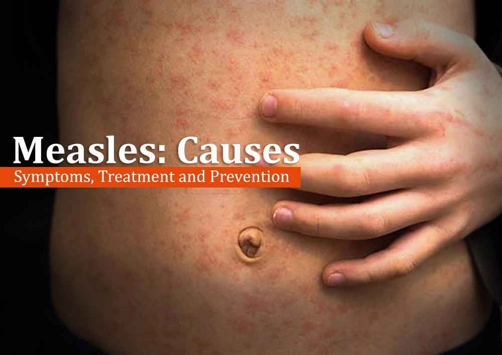 1740737106Measles Measles Causes